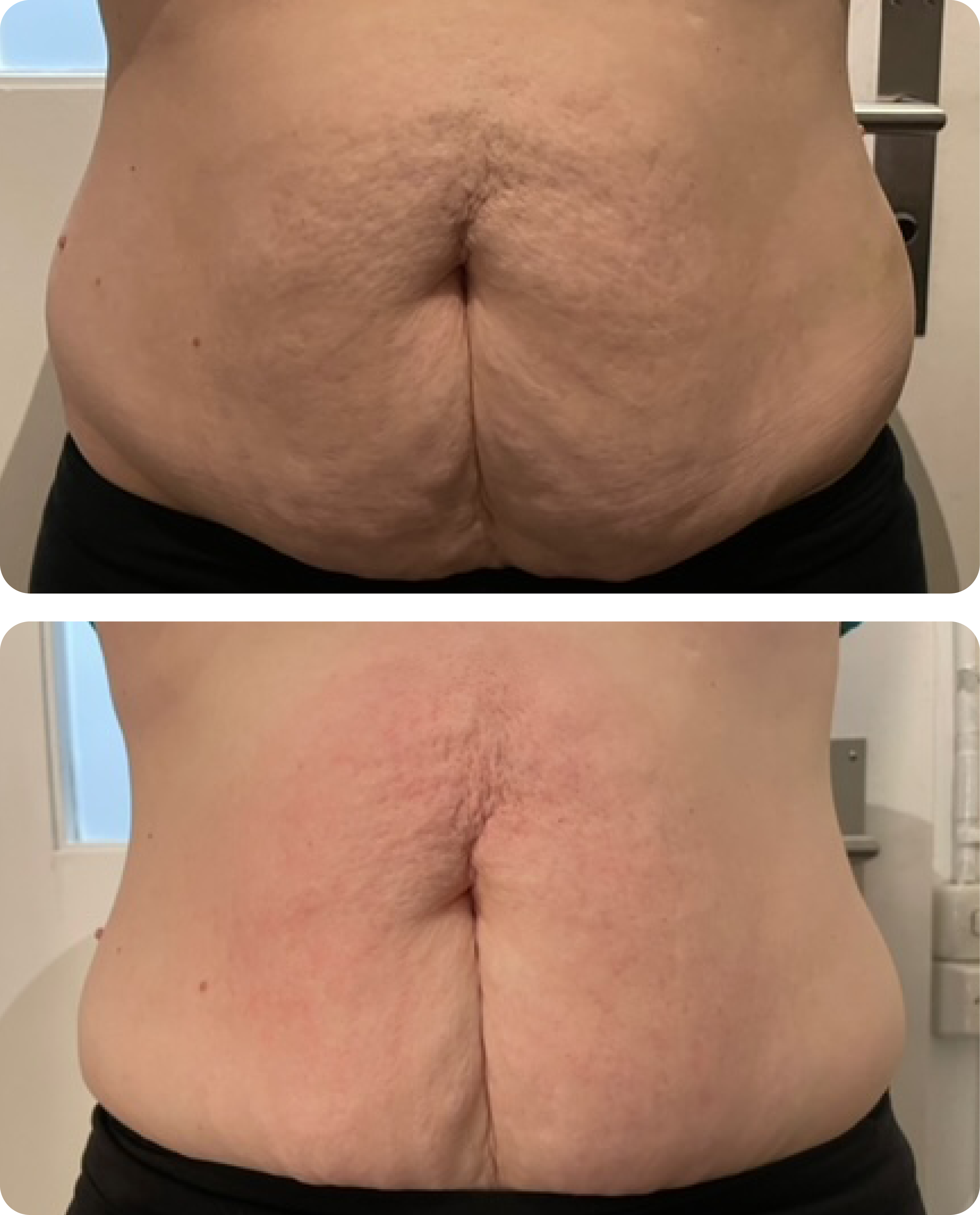 beauty-fights-fat-vorher-nachher-ultraschall-kavitation-bild-1